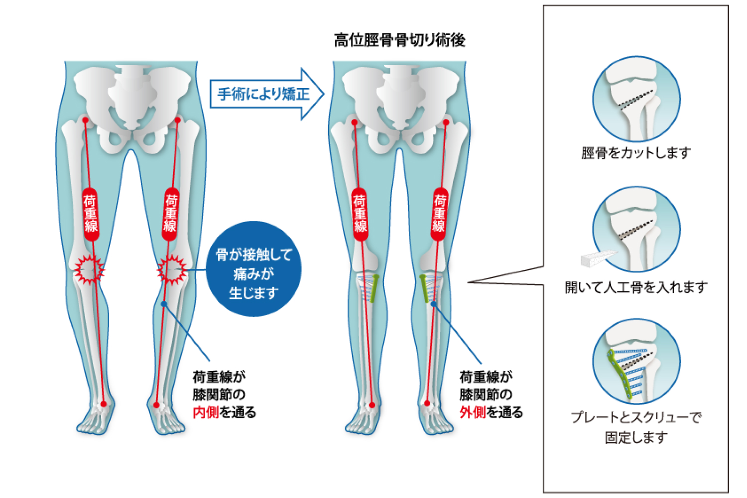 膝周囲骨切り術（HTOなど）