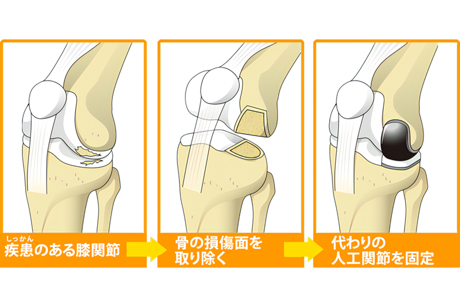 人工膝関節単顆置換術（UKA）