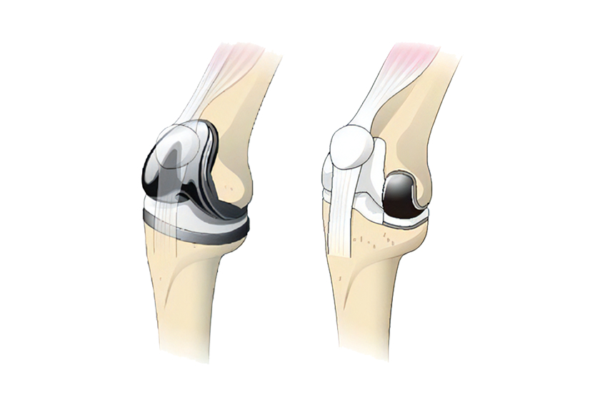 TKA（左）とUKA（右）比較イメージ