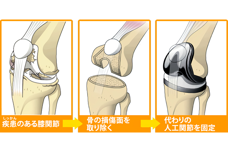 人工膝関節全置換術（TKA）