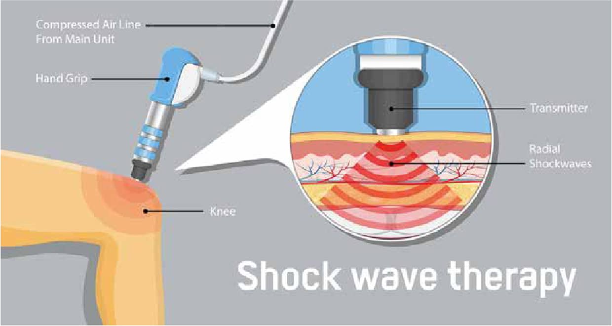 体外衝撃波に期待される作用